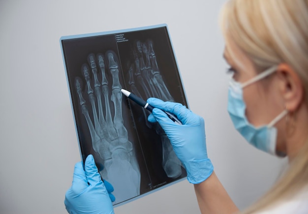 의사 또는 방사선 전문의가 사람의 다리 무릎 무릎 부상의 Xray를 보유하고 있습니다. 골절 또는 골절 진단