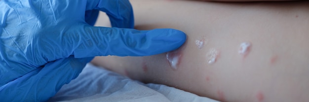 Doctor in rubber gloves applying cream to red rash of child closeup