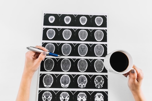 Photo doctor's hand with cup of tea and pen over mri scan of human brain