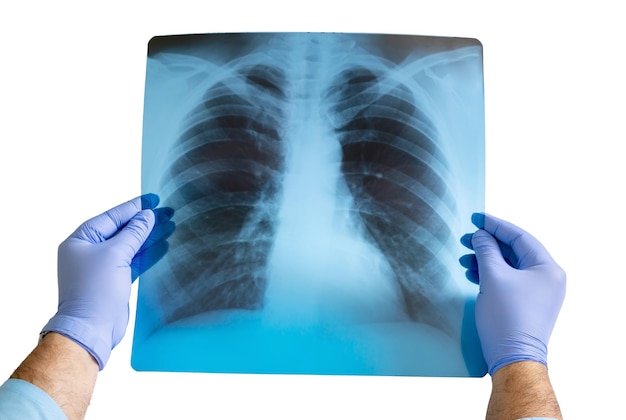 Doctor's hands in blue gloves hold an xray of the chest and lungs Isolated on white background closeup The concept of healthcare and medicine