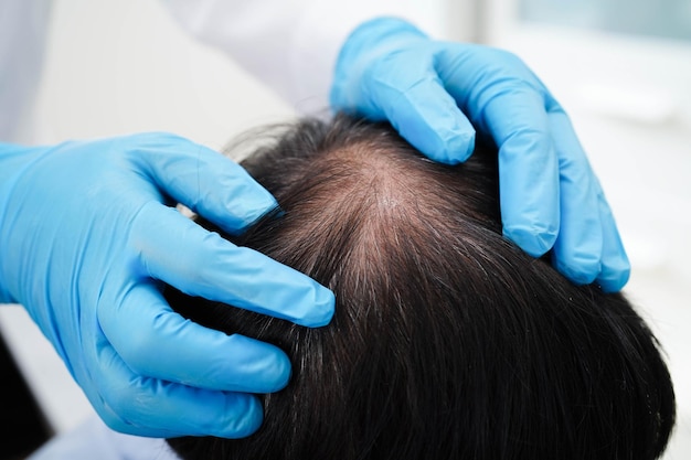 doctor touch bold head in man hair loss treatment health problem