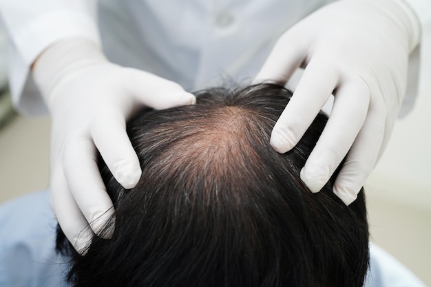 Foto il medico tocca la testa audace nell'uomo trattamento della perdita dei capelli problema di salute