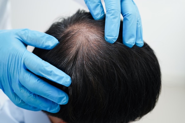 Doctor touch bold head in man hair loss treatment health problem