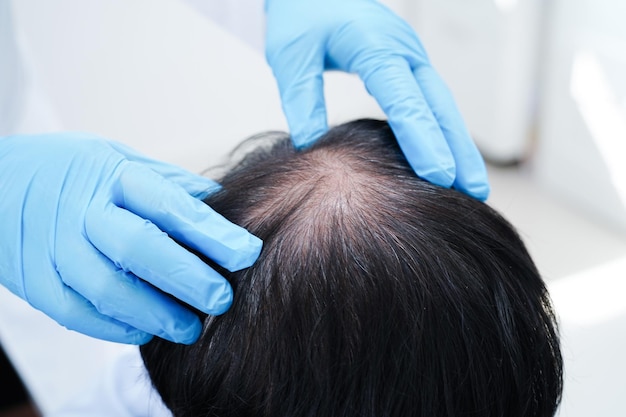 doctor touch bold head in man hair loss treatment health problem