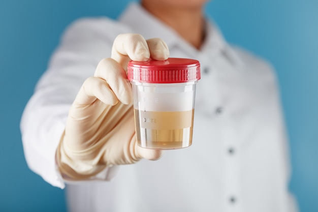 A doctor in a white coat holds a plastic container with yellow urine in his hand.