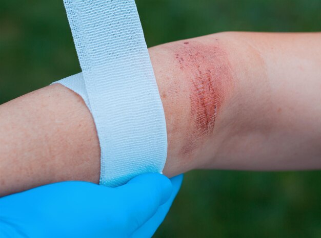 Doctors hand healing a burned skin area