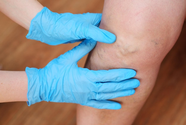 Doctors hands in rubber gloves examine the varicose veins on\
the patients legs in closeup