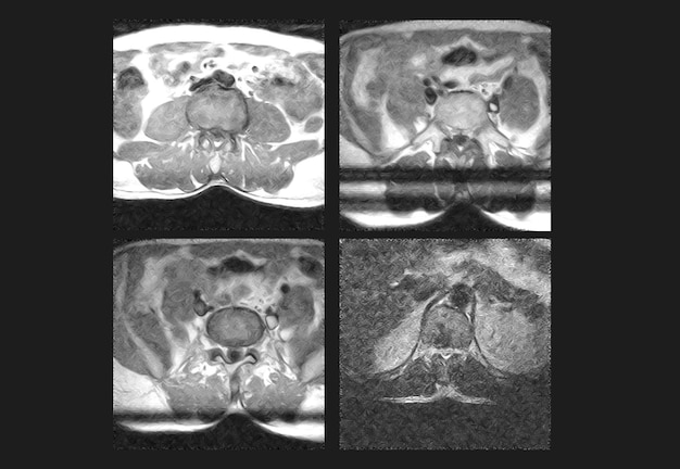 Dorsal Spine MRI and ct scan professional xray images