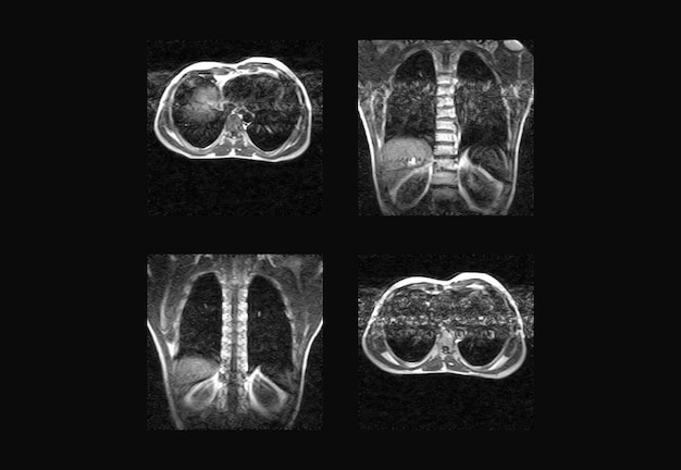 Immagini professionali di risonanza magnetica e tc della colonna vertebrale dorsale