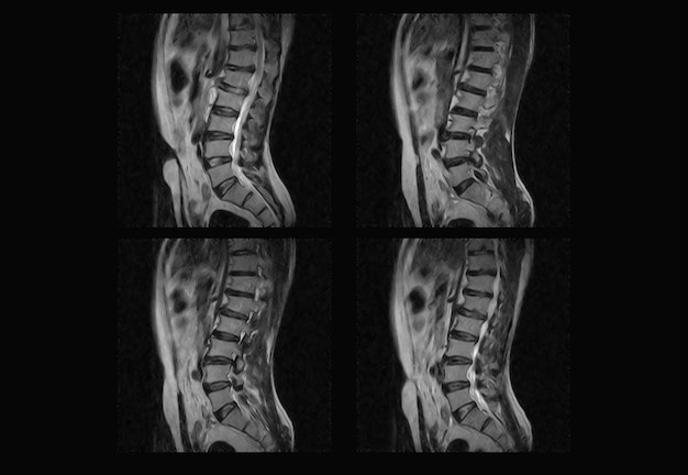 Dorsale wervelkolom MRI en ct-scan professionele röntgenfoto's