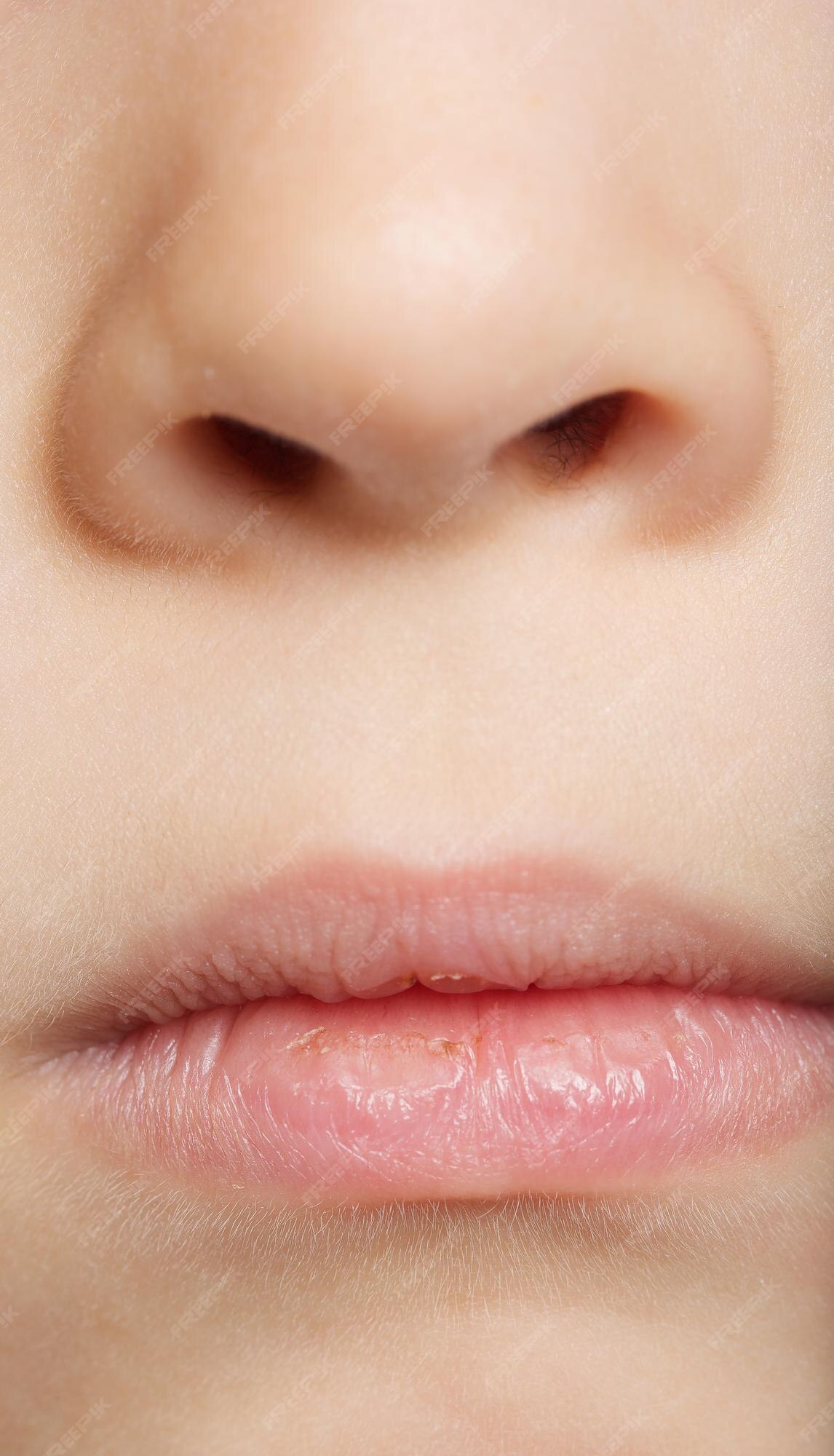 Premium Photo Dried Lip Skin Of 6 Years Old Boy Closeup premium-photo-dried-lip-skin-of-6-years-old-boy-closeup