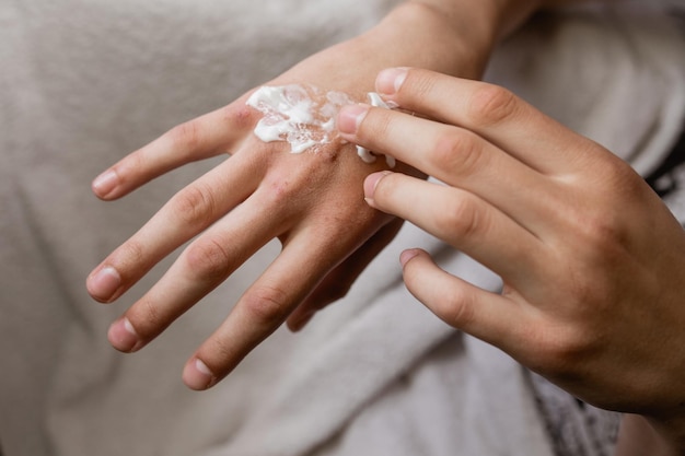 Droge handen met wonden Droge handen met wonden handcrème witte achtergrond