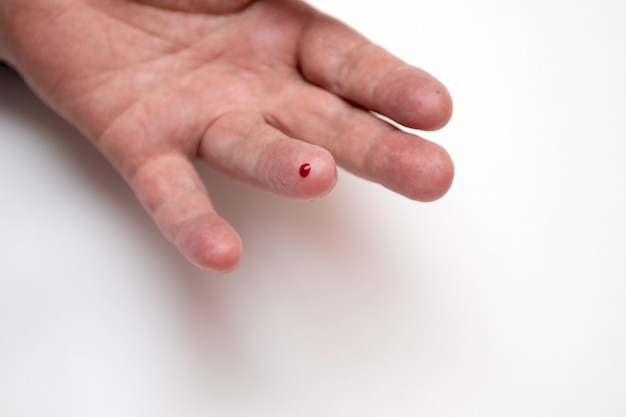 A drop of blood on a man's finger to test blood for sugar