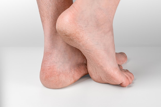 Dry and cracked soles of feet on gray background foot with dry\
heels cracked skin heel of foot with bad skin is covered with\
cracks dry skin on heel