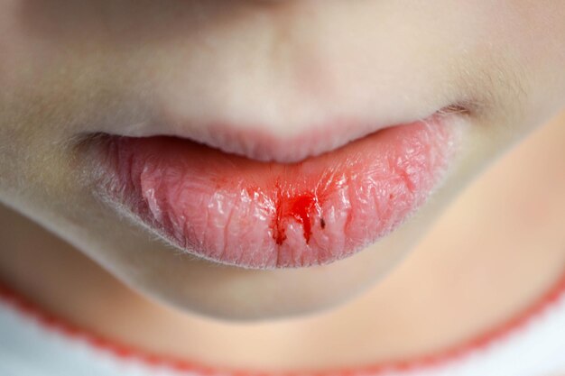 Dry and damaged lips of a girl