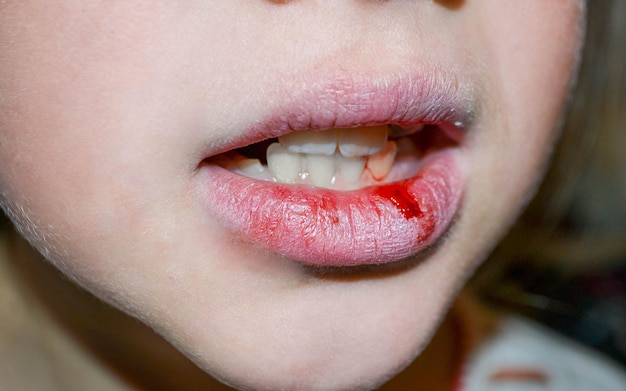 Dry and damaged lips of a girl