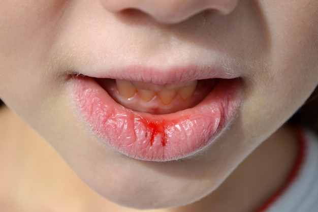 Dry and damaged lips of a girl