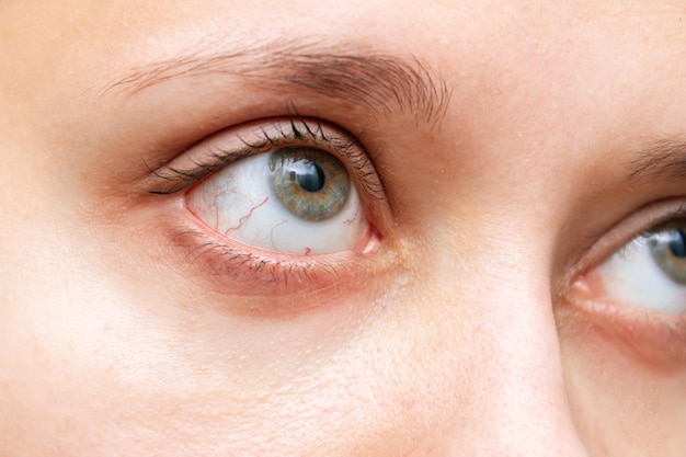 Dry eye syndrome Cropped shot of womans face with red inflamed and dilated capillaries of eyes