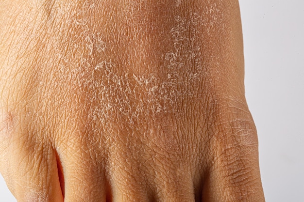 Dry skin peeling off the feet