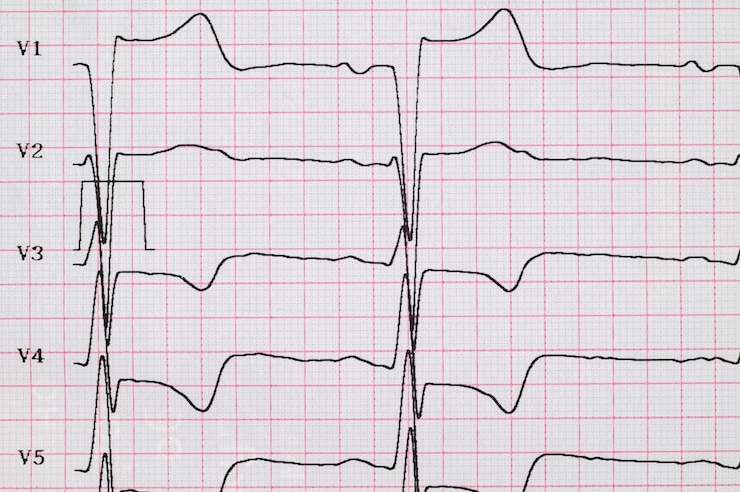 Ecg myocardial infarction on ecg subendocardial ischemia in chest leads angina chest pain closeup