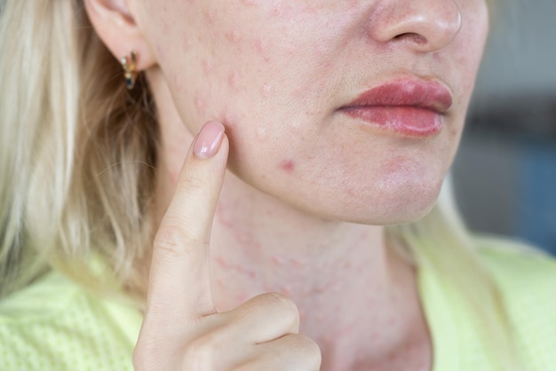 Foto echte huid biorevitalisatie op witte achtergrond. sporen van biorevitalisatie-injecties op vrouwengezicht. biorevitalisatie naaldafdrukken schoonheidsbehandeling echte papels na hyaluronzuurinjectie close-up.