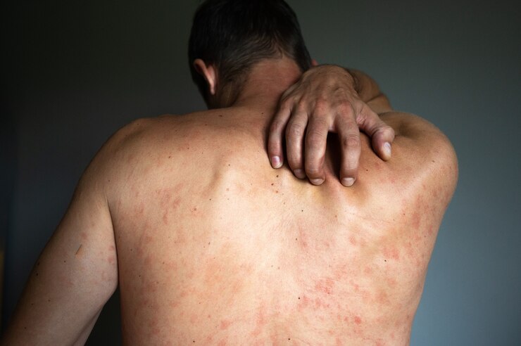 Eczema concept. Man suffers from skin irritation isolated on gray background. Itchy back with allergy rash