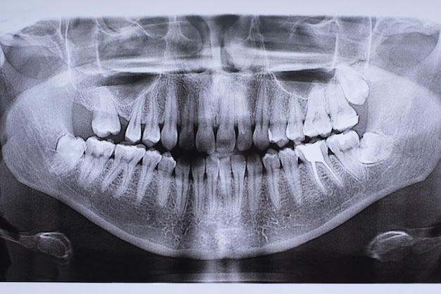 een afbeelding van een kaak met een geïmplanteerde tand