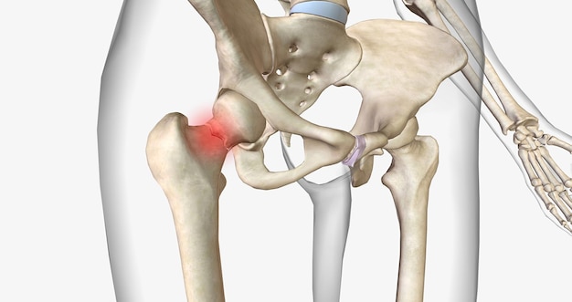 Foto een femurhalsfractuur is een soort heupfractuur die optreedt in het deel van het dijbeen dat zich het dichtst bij het bekken bevindt