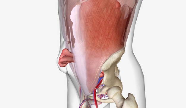 Foto een incisionele ventrale hernia is het meest voorkomende type ventrale