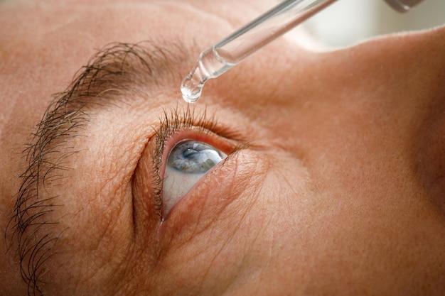 Een man bevochtigt zijn ogen voordat hij contactlenzen installeert. druppels in de ogen door irritatie, roodheid en allergieën.