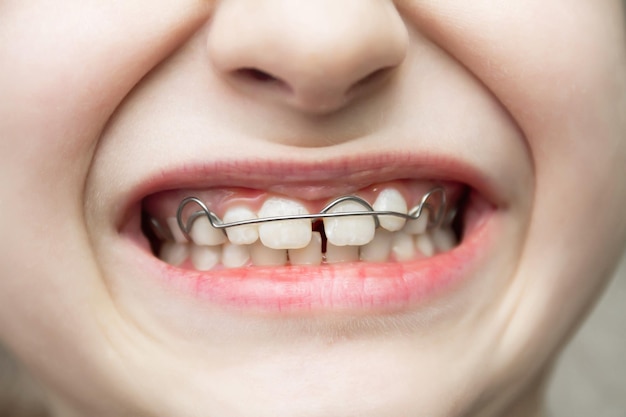 Een meisje met een verwijderbaar orthodontisch apparaat om de beet te corrigeren