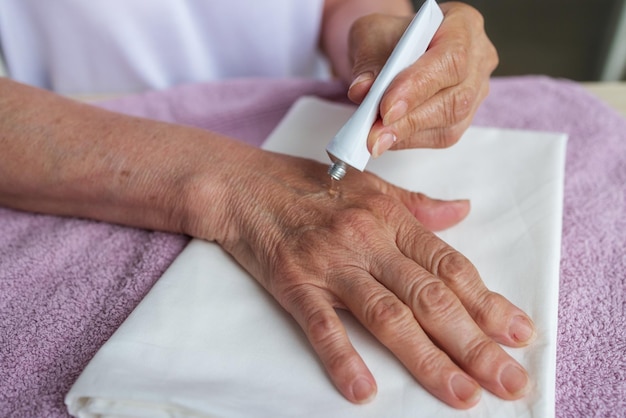 Een oudere vrouw brengt helende crème voor artritis aan op haar oude handen medicijn