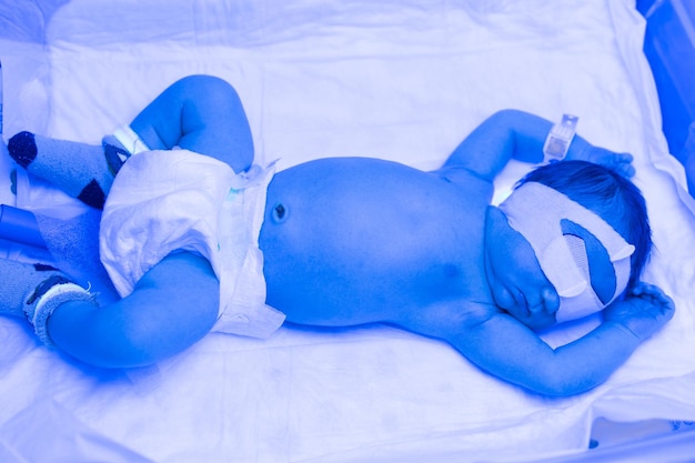 Een pasgeboren baby ligt onder ultraviolette lampen onder blauw licht Hoge bilirubinebehandeling van geelzucht ultraviolette incubator bij kinderen