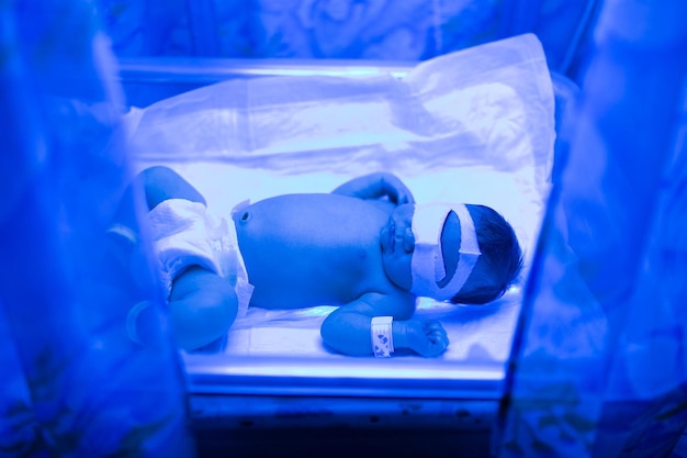 Een pasgeboren baby ligt onder ultraviolette lampen onder blauw licht Hoge bilirubinebehandeling van geelzucht ultraviolette incubator bij kinderen