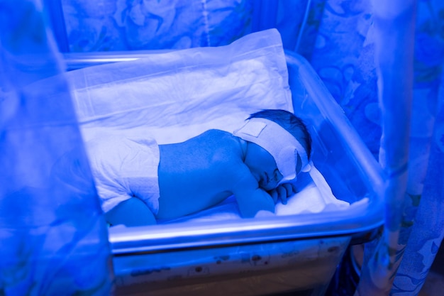 Een pasgeboren baby ligt onder ultraviolette lampen onder blauw licht Hoge bilirubinebehandeling van geelzucht ultraviolette incubator bij kinderen