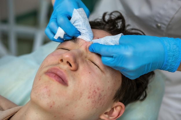 Een schoonheidsspecialist behandelt acne bij een tiener wiens gezicht bedekt is met puistjes en rode vlekken