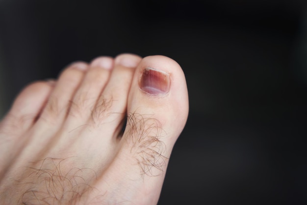 Een teen is gewond een zwaar voorwerp is op de vinger gevallen Hematoom onder de nagel