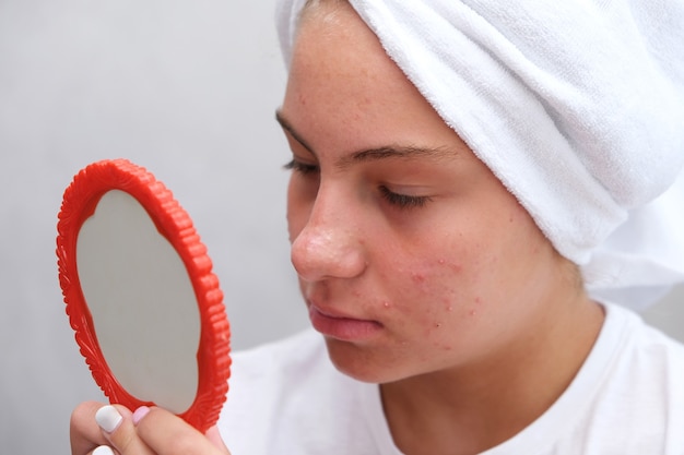 Een triest tienermeisje kijkt naar de puistjes op haar gezicht in de spiegel. problematische huid bij adolescenten. acne.