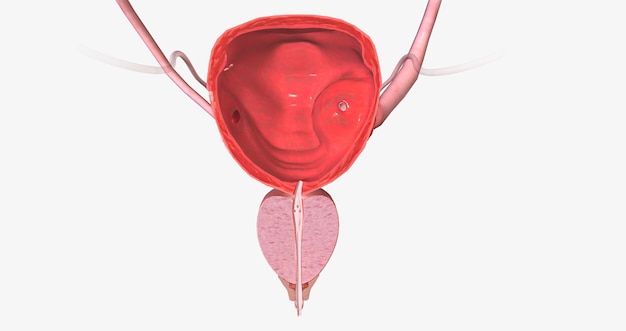 Foto een ureterocele is een aangeboren afwijking van de urineleider, de buis die urine van de nier naar de urineblaas transporteert