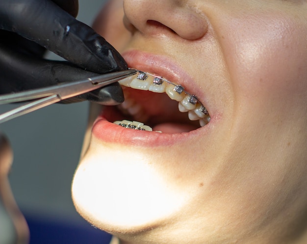 Een vrouw met een beugel bezoekt een orthodontist in de kliniek in een tandartsstoel