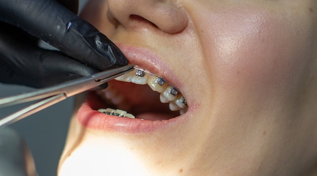 Een vrouw met een beugel bezoekt een orthodontist in de kliniek in een tandartsstoel