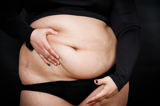 Een vrouw met een dikke buik en striae op haar huid op een zwarte achtergrond zwaarlijvig persoon Foto van hoge kwaliteit