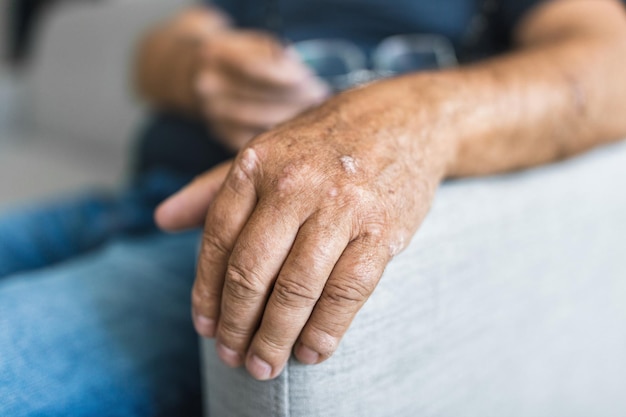 Elderly man suffering from psoriasis on hands