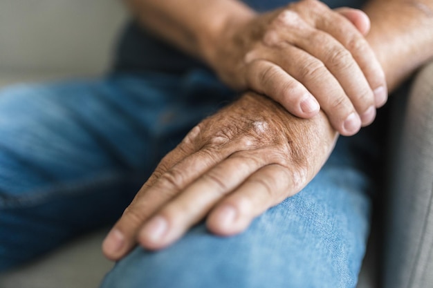 Foto uomo anziano che soffre di psoriasi sulle mani