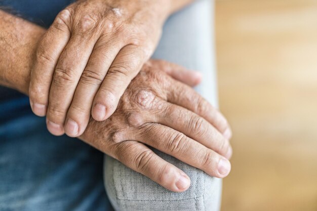 Elderly man suffering from psoriasis on hands