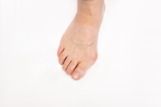 Elderly woman's foot with hallux valgus deformity of big toe caused by wearing uncomfortable shoes