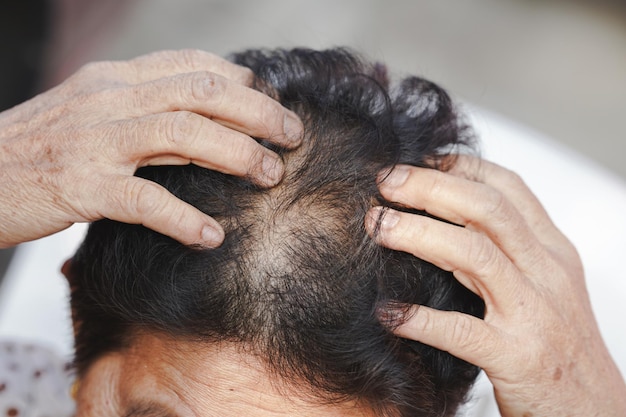 Elderly women have thinning hair due to hair loss