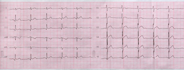 Photo electrocardiogram closeup on paper cardiology and health care
