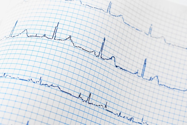 Elektrocardiogram in papieren vorm close-up