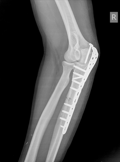 Elleboog Een olecranon breuk mijn worden samengehouden met plaat en schroeven.